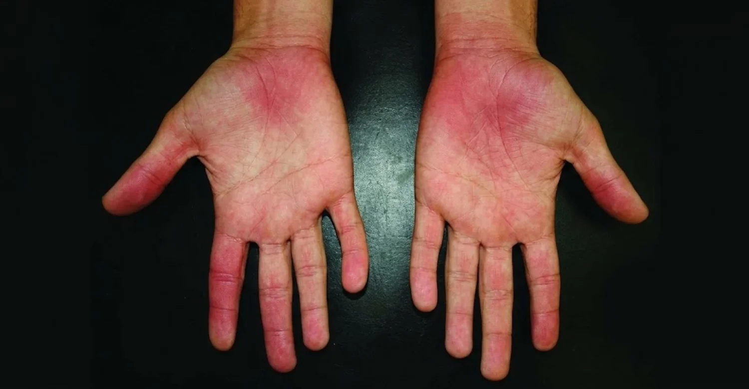 Erythromelalgia and Premature Tooth Loss1